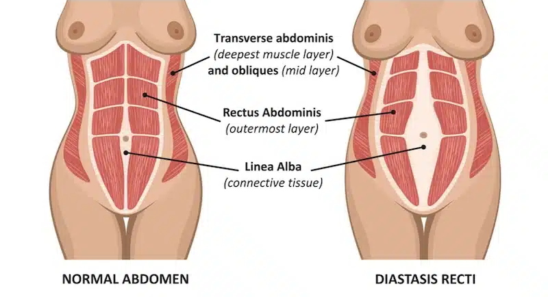 The Science of Closure: How HIEMT Repairs Diastasis Recti Without Surgery