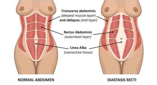 The Science of Closure: How HIEMT Repairs Diastasis Recti Without Surgery